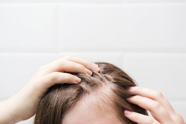 Associer microneedling et PRP contre la chute de cheveux