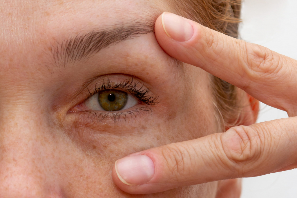 Comparatif blépharoplastie médicale vs chirurgicale