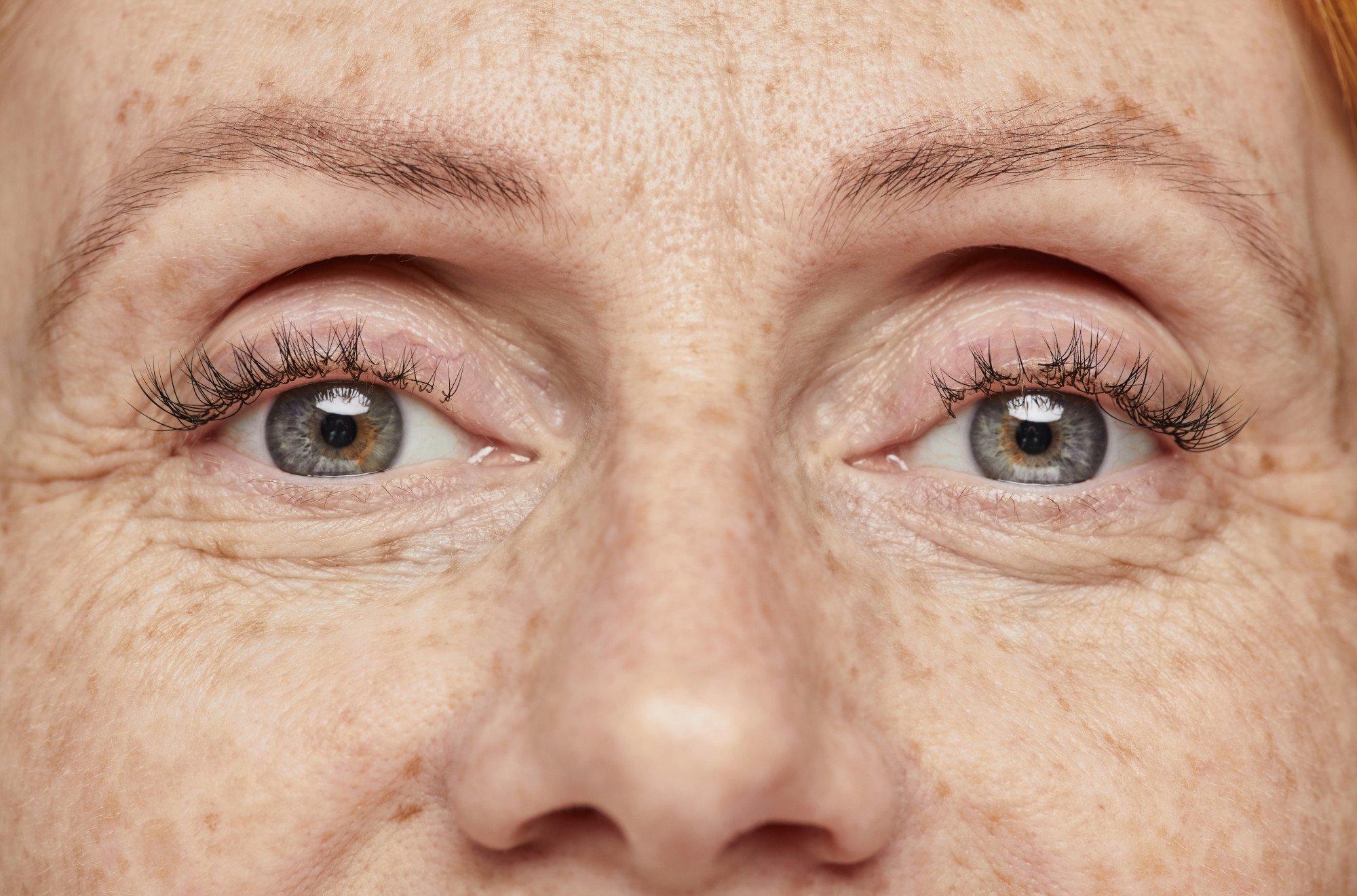 Blépharoplastie Médicale à Jacou