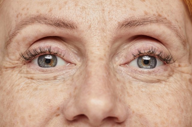 Blépharoplastie médicale Silkplex