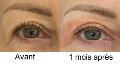 Après 1 séance de Silkplex 
